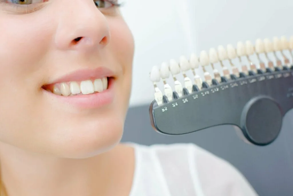 Lady smiling to show teeth for color match