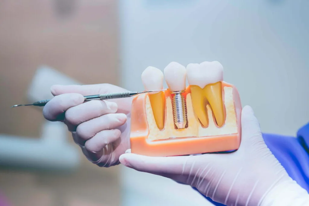 Tooth implant
