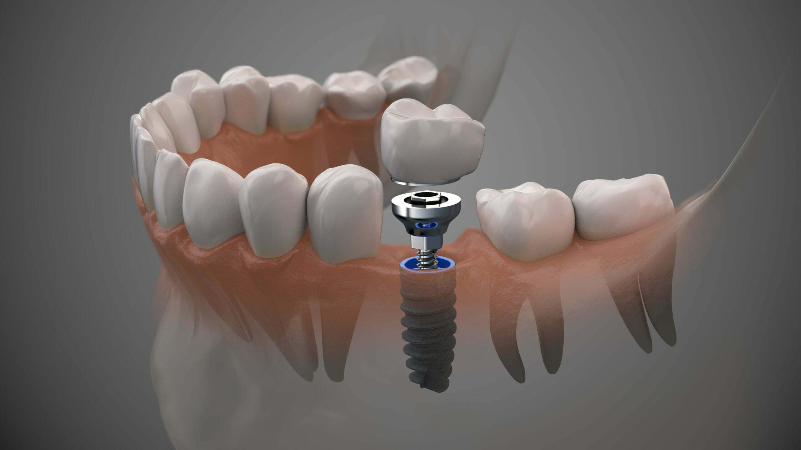 Tooth human implant. On1 concept.