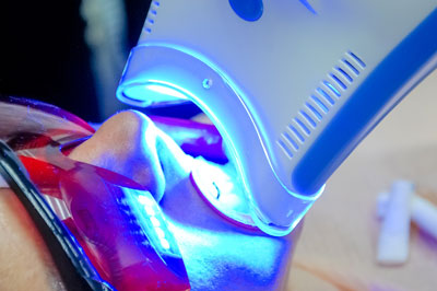 Laser Light Teeth Whitening