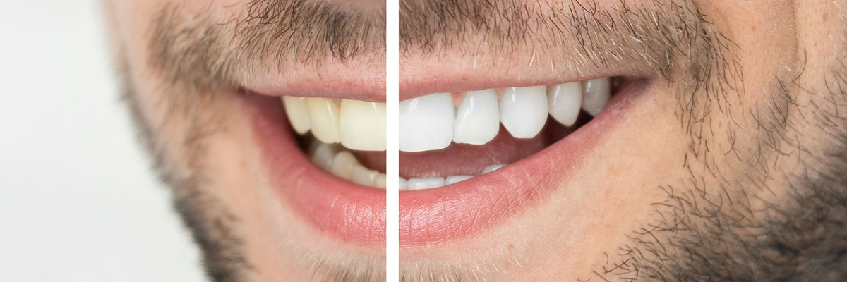 Whiter Smile Before and After