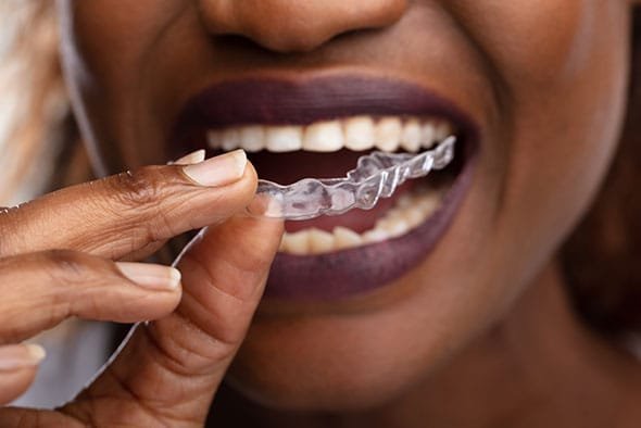 Invisalign