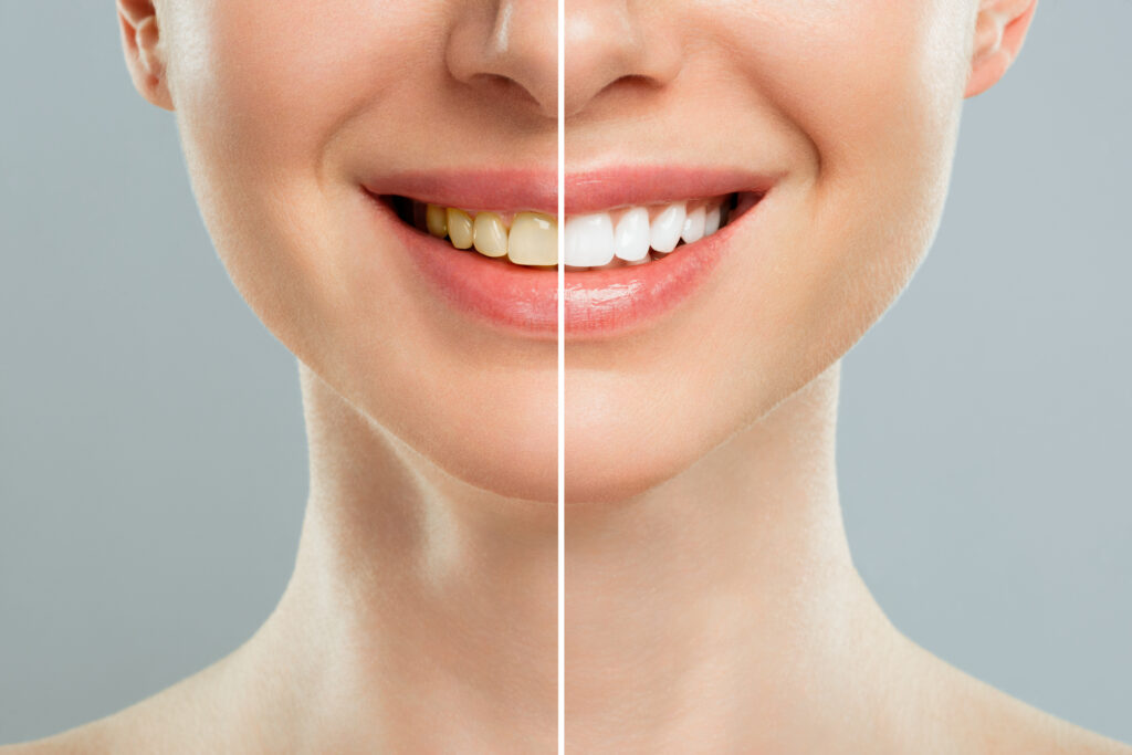 Before and after teeth whitening