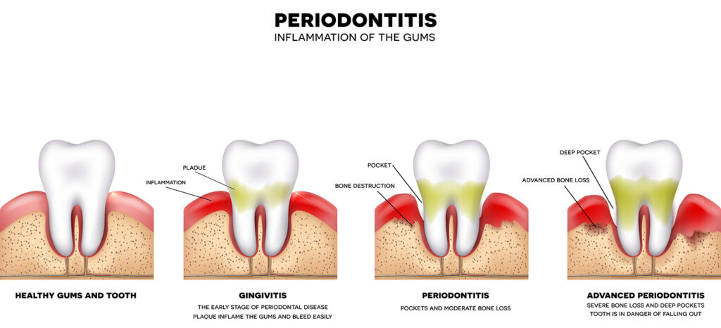 Diagram of periodontitis 