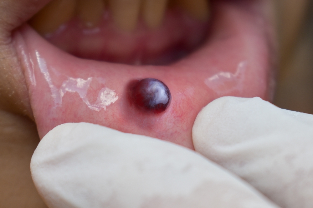 Managing A Blood Blister In Your Mouth