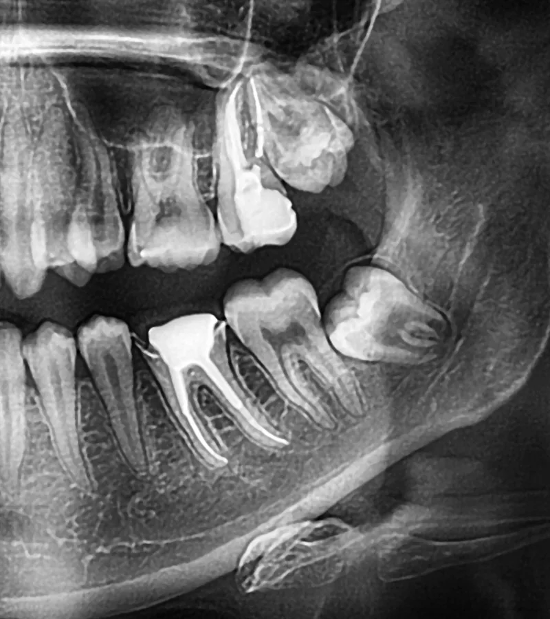 X-ray with a wisdom tooth breaking up