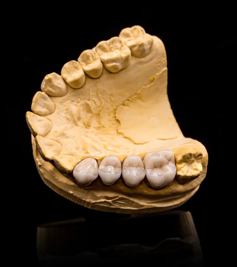 Close-up of a dental bridge model at Aesthetique Dental Care in Leeds, demonstrating how missing teeth are replaced with a natural-looking restoration in Leeds