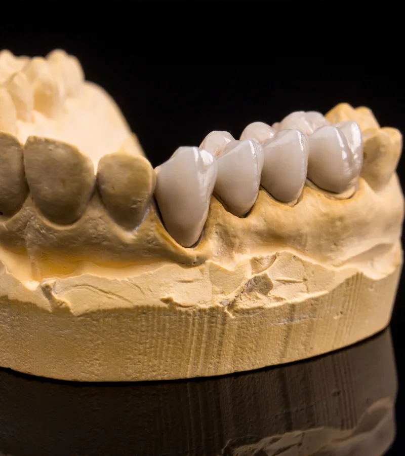Close-up of a dental bridge model at Aesthetique Dental Care in Leeds, demonstrating how missing teeth are replaced with a natural-looking restoration.