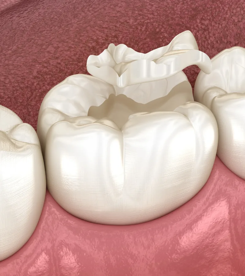 Dental illustration of a temporary inlay placed to protect a tooth before the final restoration at Aesthetique Dental Care in Leeds.