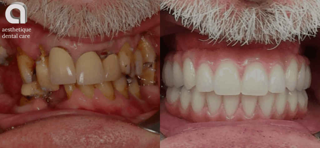 how much is a full set of dental implants uk - before and after treatment