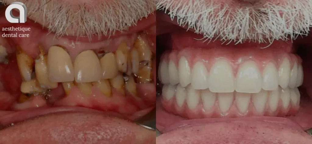 how much is a full set of dental implants uk - before and after treatment