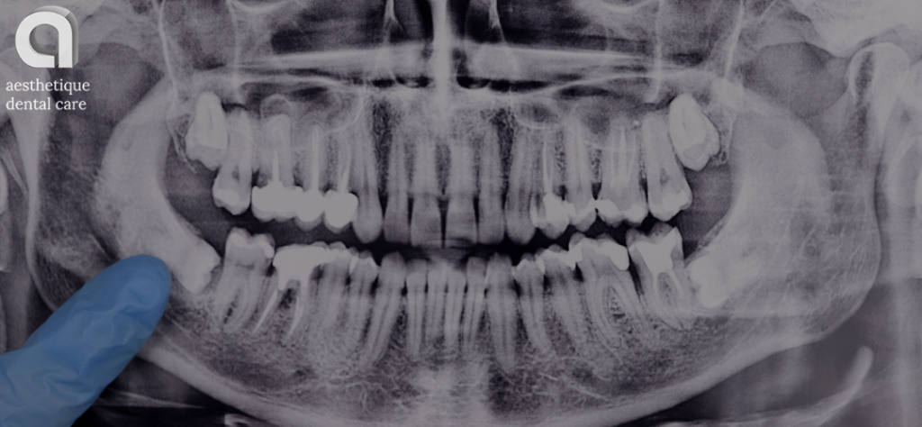 how long does wisdom tooth pain last - X-rays with partially erupted wisdom tooth